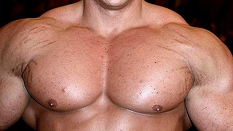 stretch marks